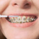 Woman brushes her teeth with braces using a toothbrush. Gentle cleaning of the teeth. Close-up, front view. High quality photo